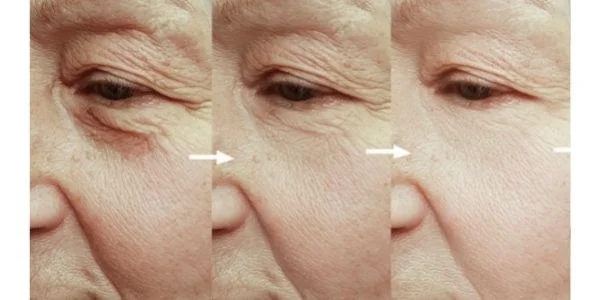 the best facial for anti aging & wrinkle